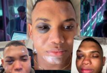 Photo of Abraham Polo Polo mostró su rostro tras sufrir una presunta caída en monopatín